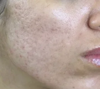 8 months after 2 treatments