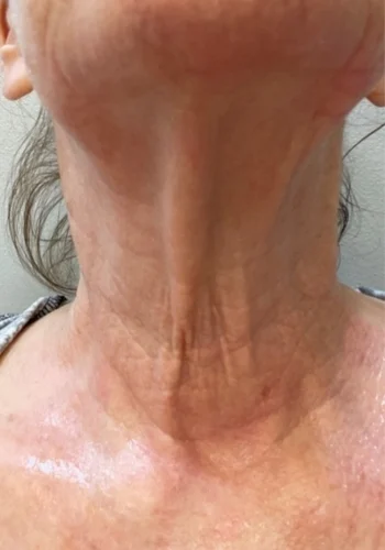 6 months after 1 treatment
